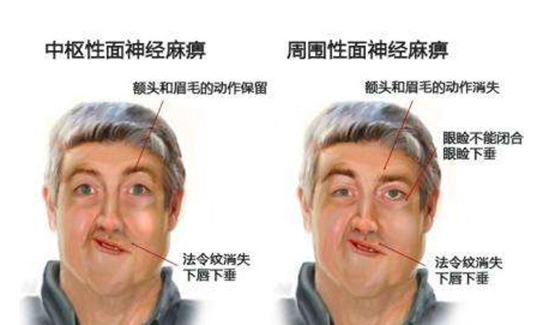 面神经麻痹：面对困扰的解决之道