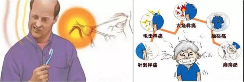 面部神经疾病的治疗与康复：一步步走出阴影