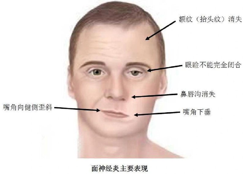 面神经麻痹,一种让人困扰的疾病!你知道它有哪些症状和治疗方法吗?