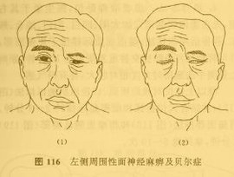 面神经麻痹,一个让人头疼的词汇,如何在日常生活中有效应对?本文将通过具体案例和实用操作指南,帮助你了解并解决这一常见问题。