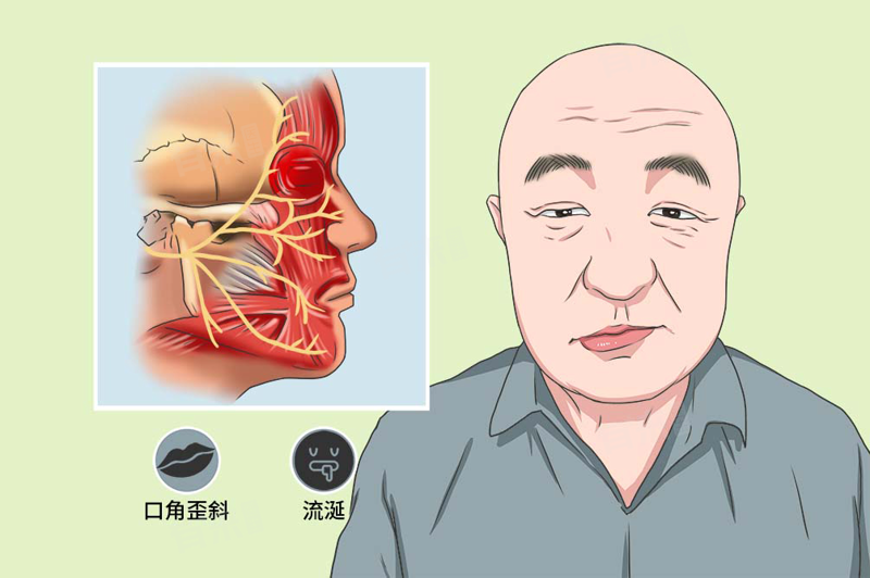 面神经炎:如何有效应对面部肌肉无力